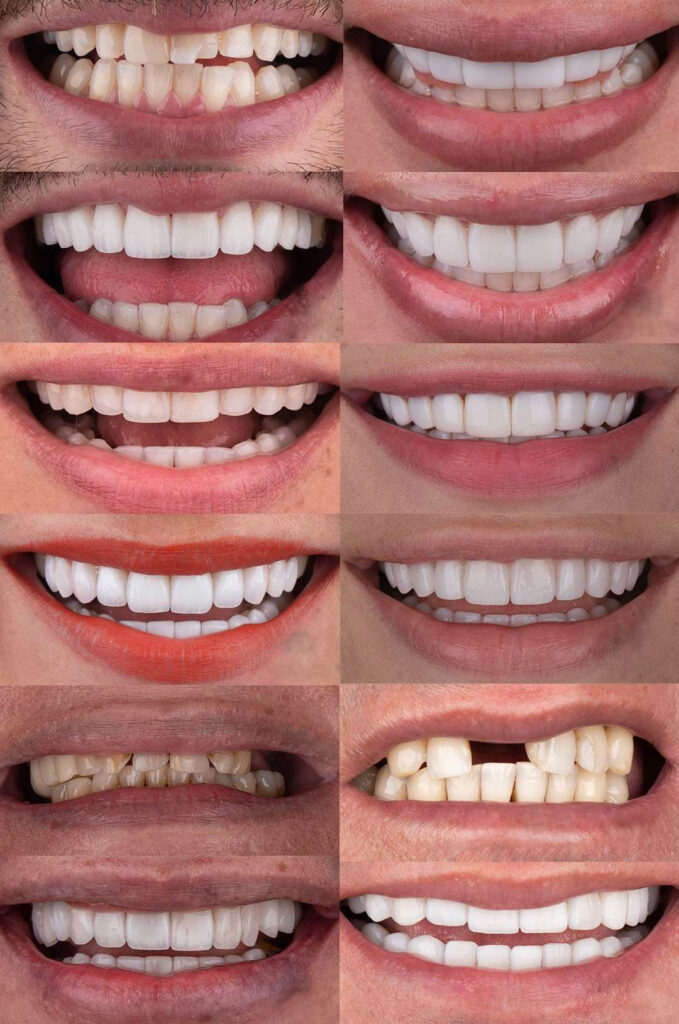 Veneers in Colombia Customers